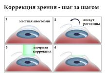 Главные аспекты  коррекции зрения