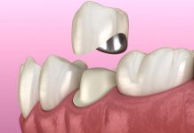 Обзор металлокерамических коронок Duceram