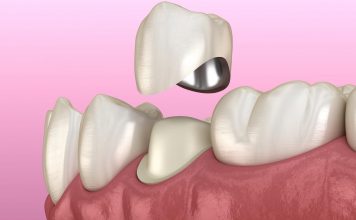 Обзор металлокерамических коронок Duceram